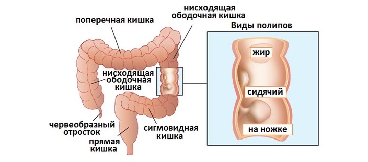 Основную опасность полип представляет, если его клетки начинают активно пролиферировать Схема
