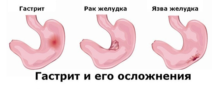 Гастрит может привести к развитию язвы и рака желудка Осложнения гастрита