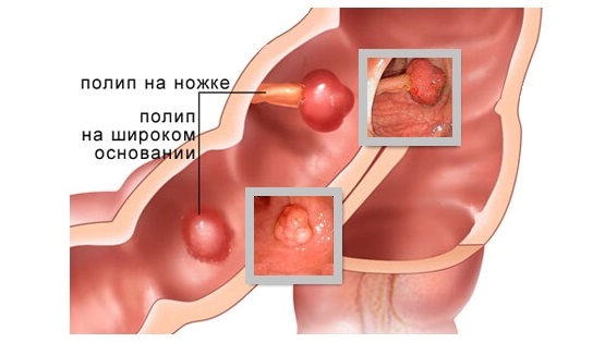 Полипы