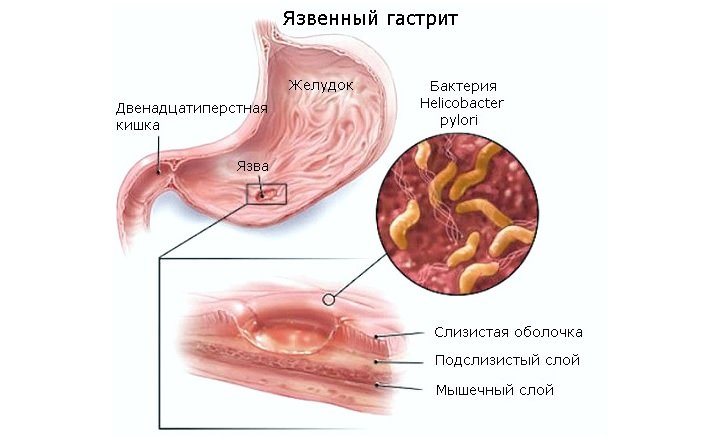 Схема язвенного гастрита желудка Язвенный гастрит